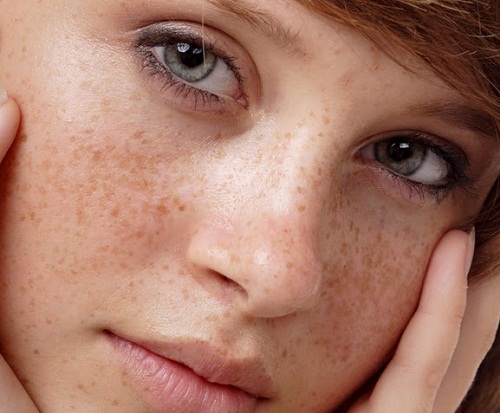Mách bạn những mẹo đơn giản để phân biệt nám và tàn nhang trên da mặt