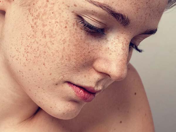 Mách bạn những mẹo đơn giản để phân biệt nám và tàn nhang trên da mặt